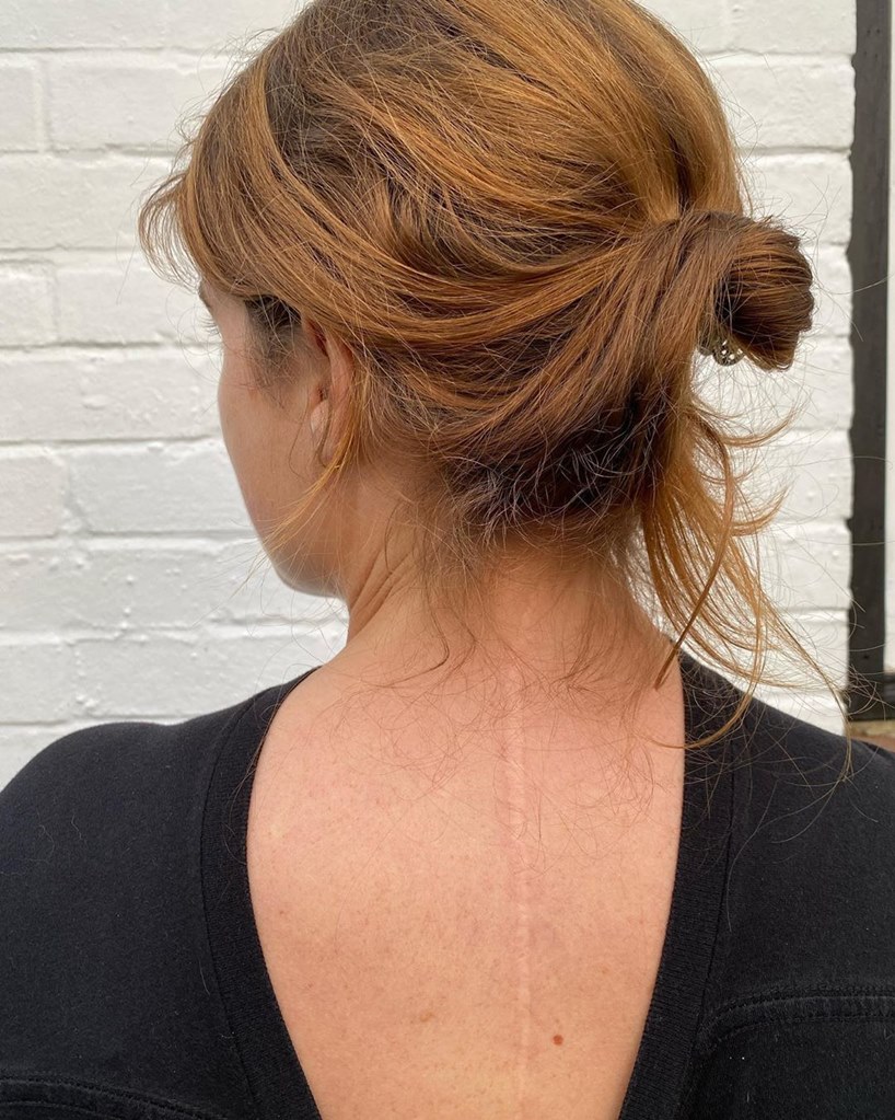 Princess Eugenie Scoliosis Scar Picture Now Pregnant With First Baby